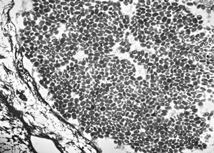 poxvirus - molluscum contagiosum poxvirus - molluscum contagiosum